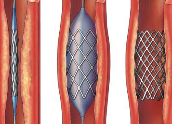好消息！700元冠脈支架來(lái)了帶量采購(gòu)結(jié)果在甘肅省正式落地執(zhí)行